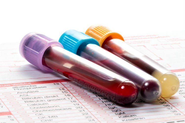 Read more about the article PCOS Test